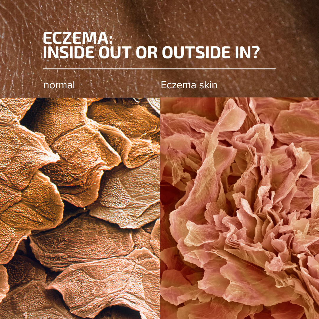 Comparison of normal skin and eczema skin under a microscope with text 'Eczema: Inside Out or Outside In?'