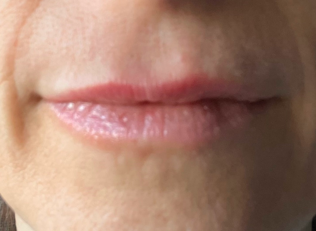 After treatment