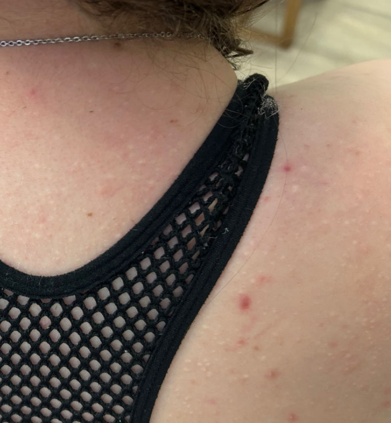After treatment