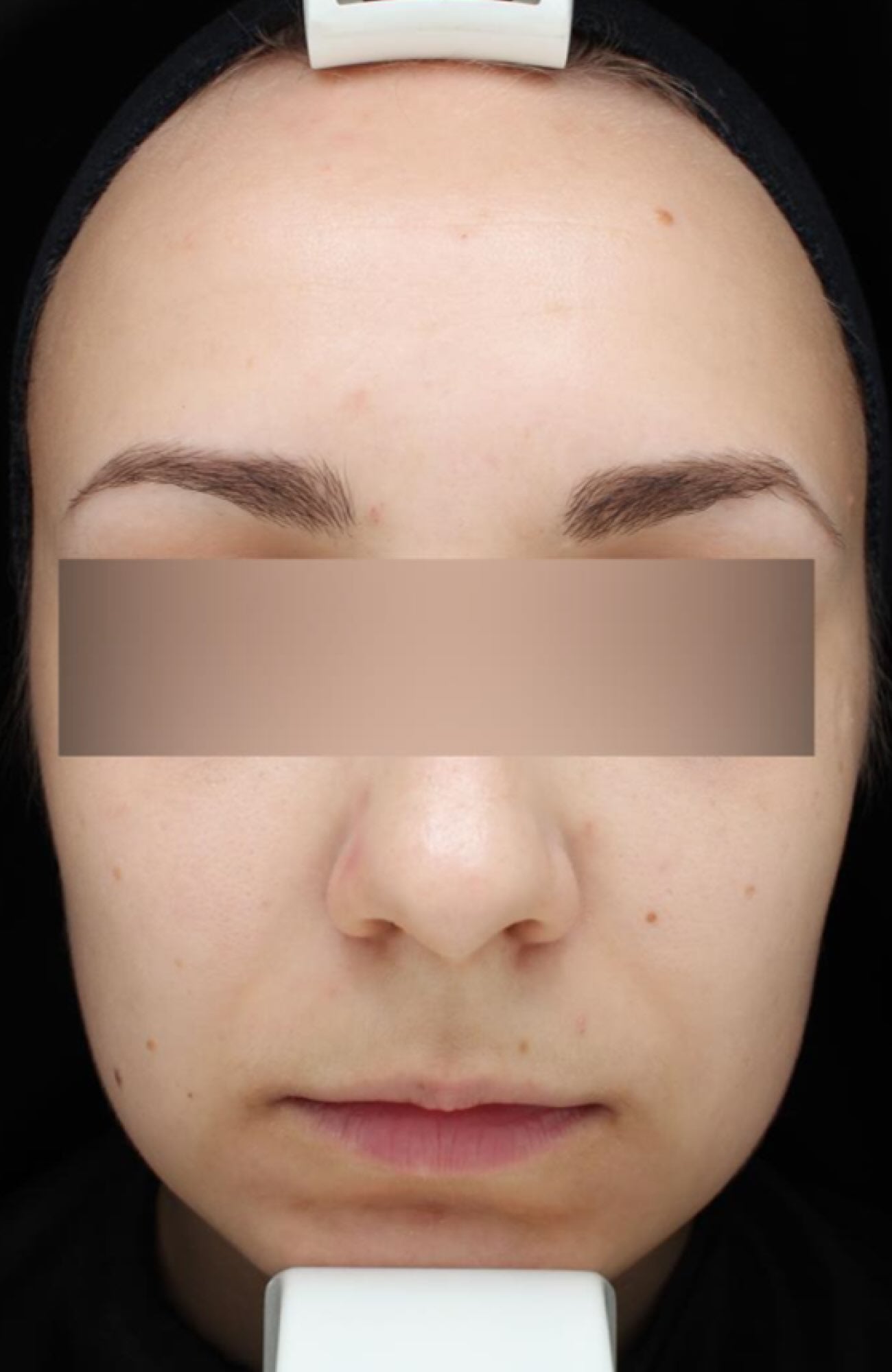 After treatment