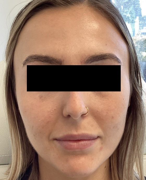 After treatment