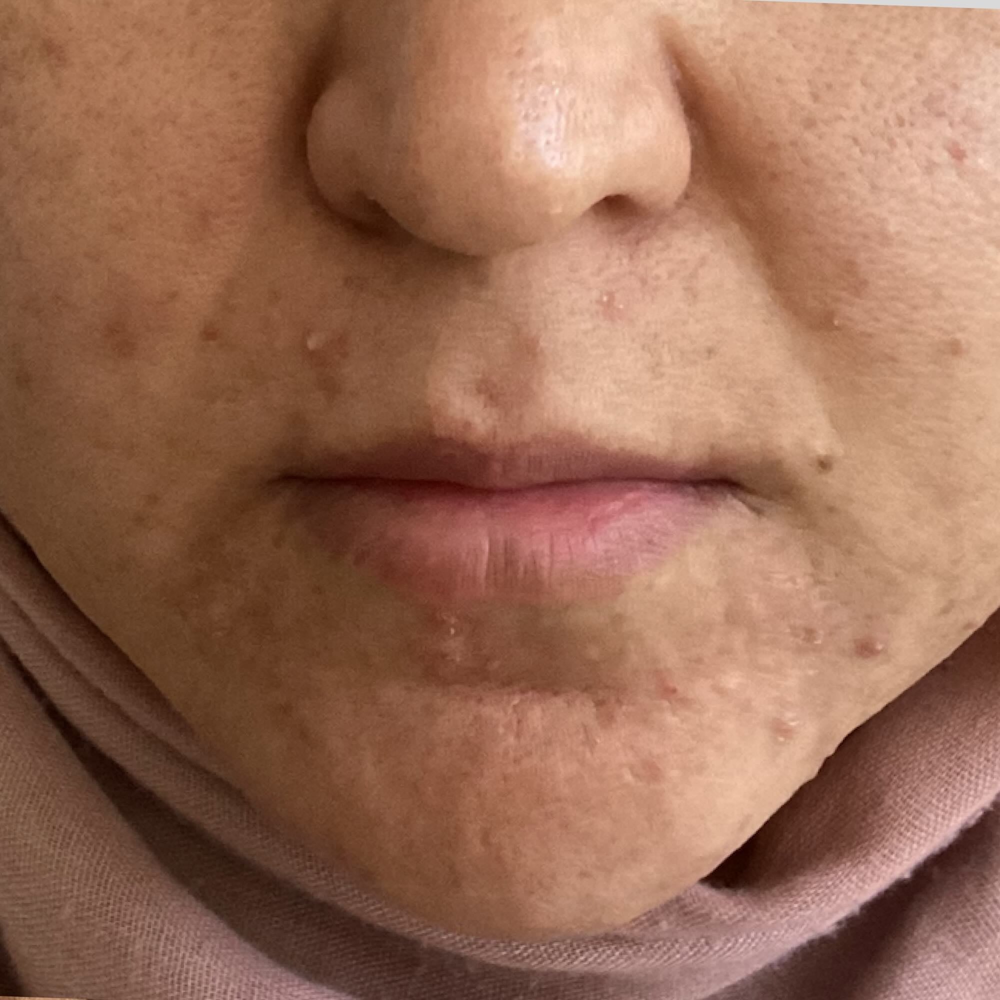 After treatment