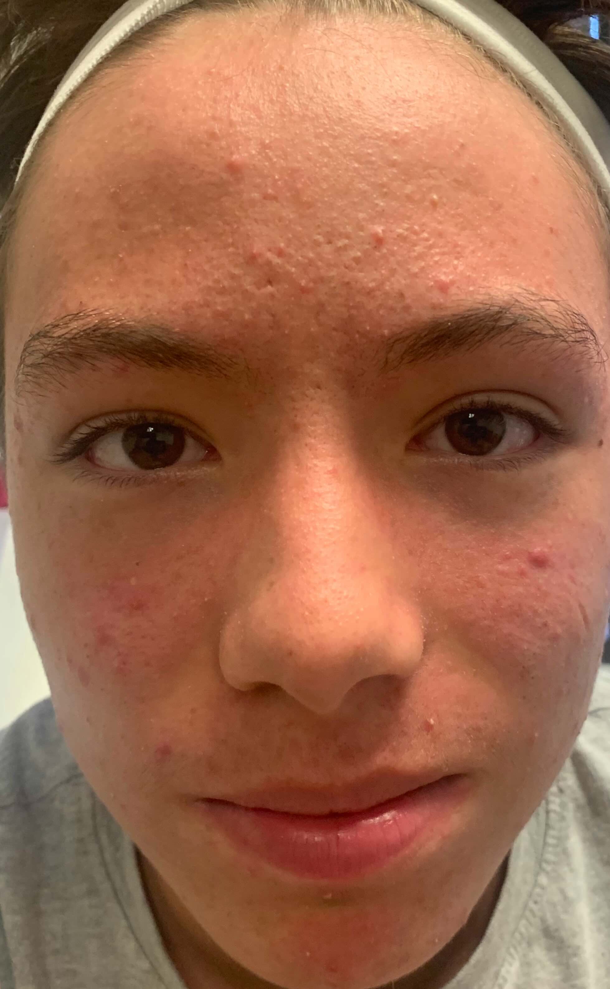 After treatment