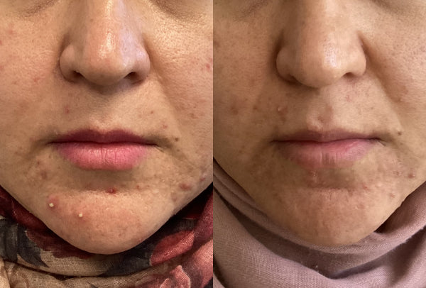 Before and after image of Angela's face.