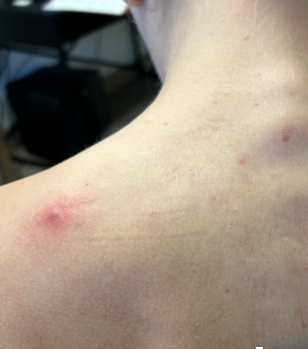 Before treatment