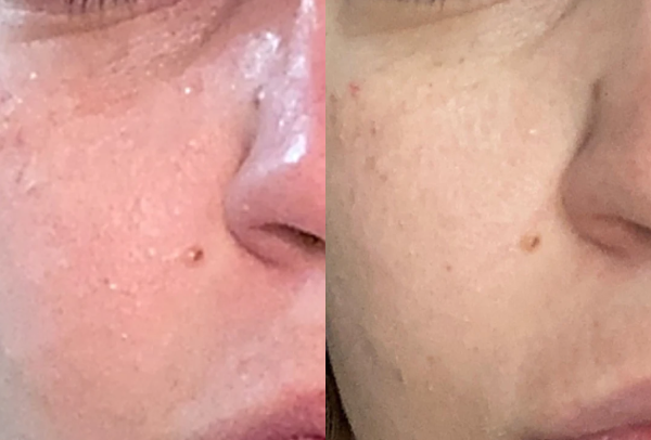 Before and after image of a persons cheek and the changes in their skin.
