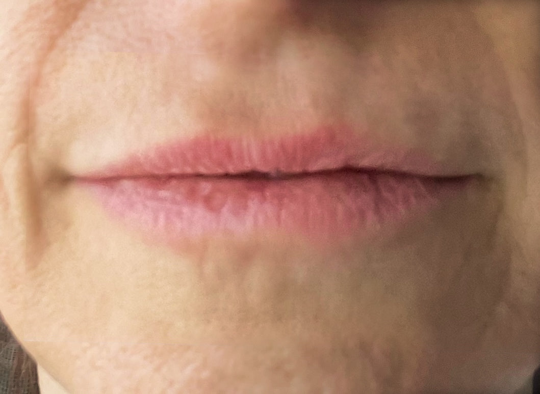 Before treatment