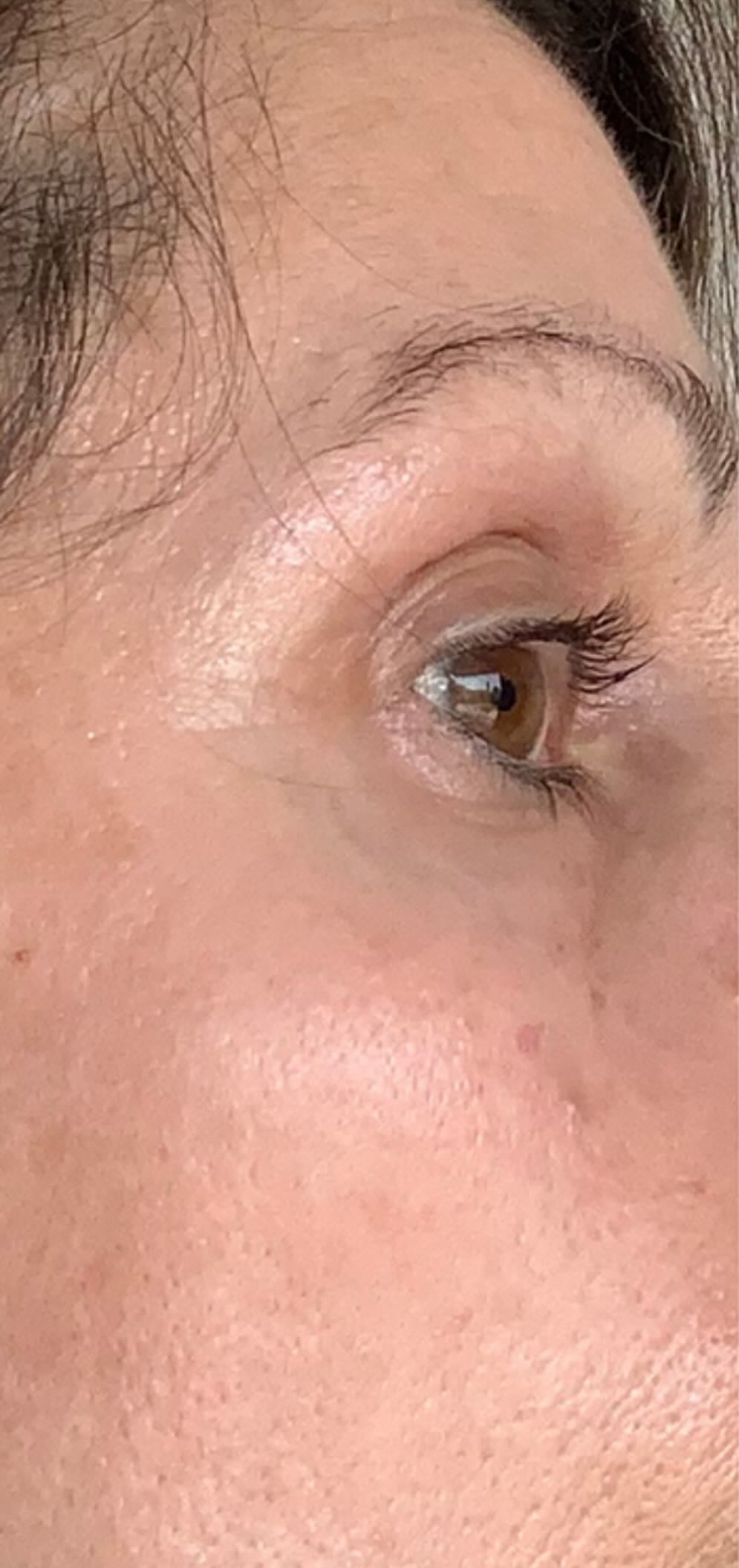 Before treatment