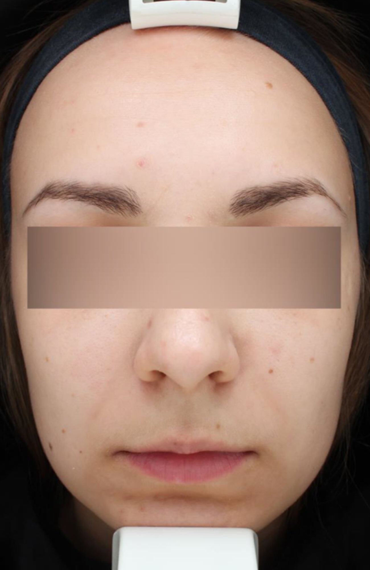 Before treatment