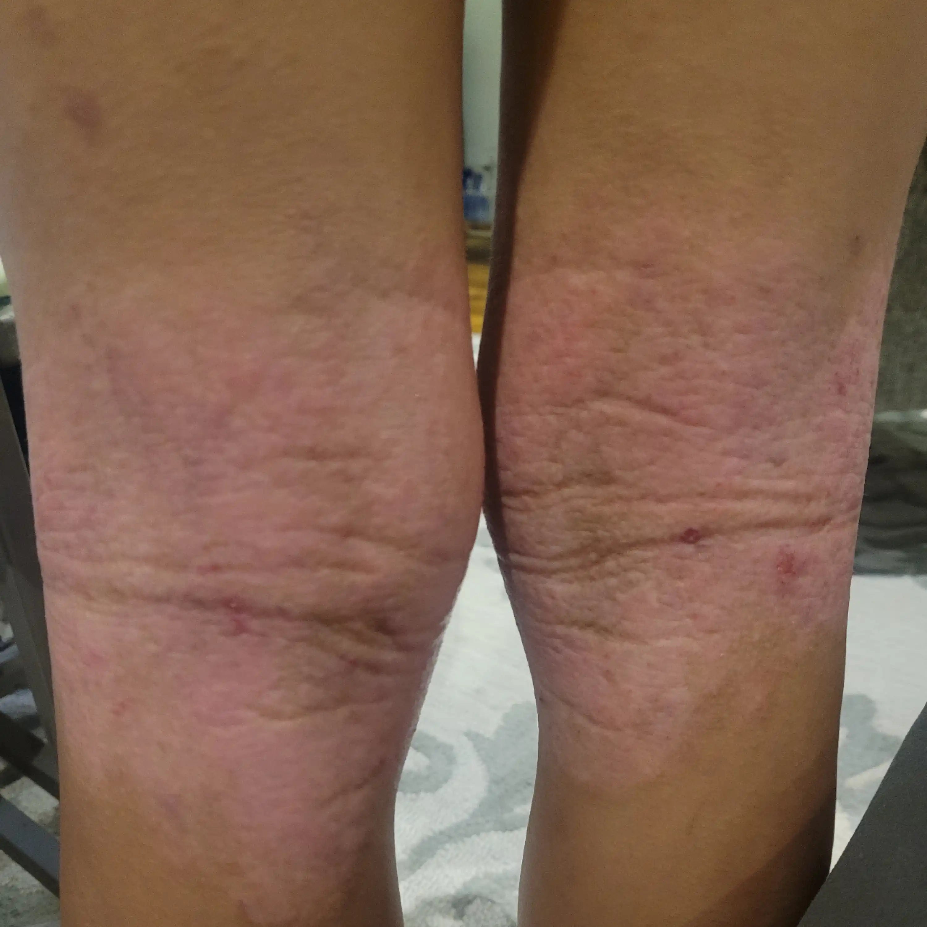 Before treatment