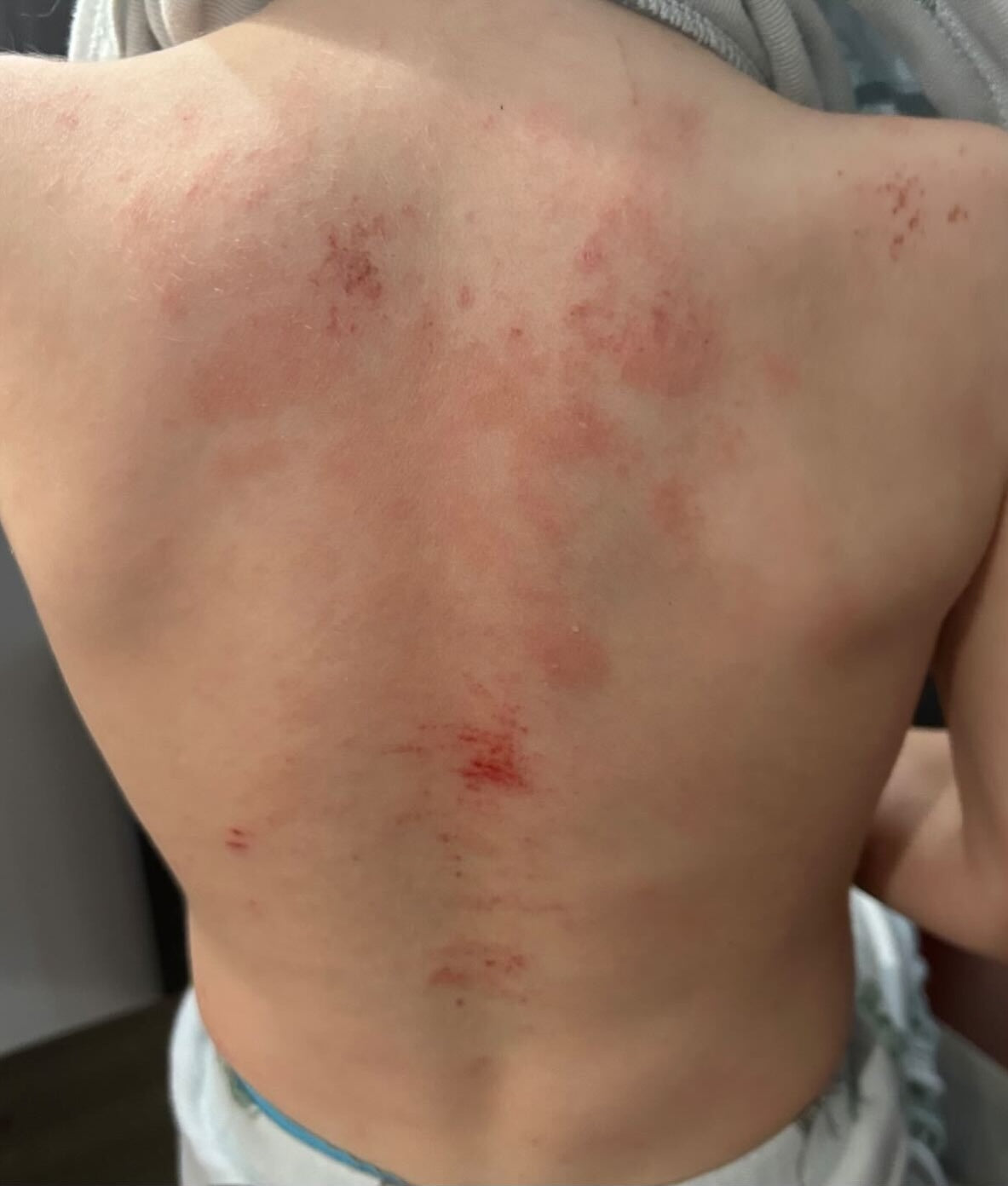 Before treatment