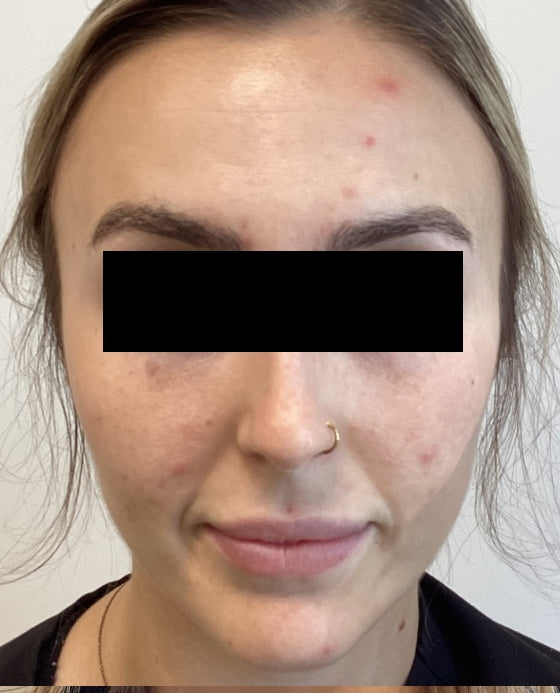 Before treatment