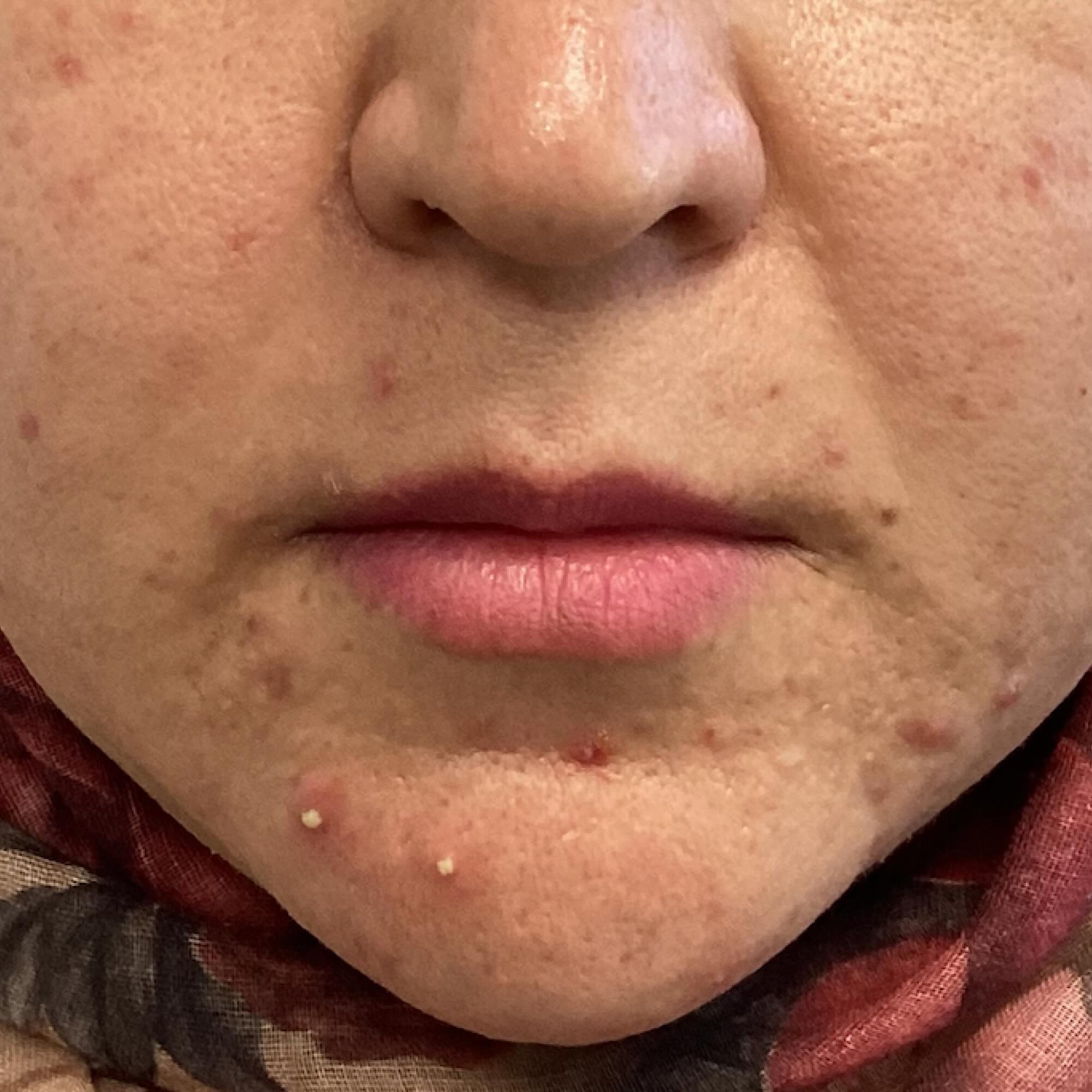 Before treatment