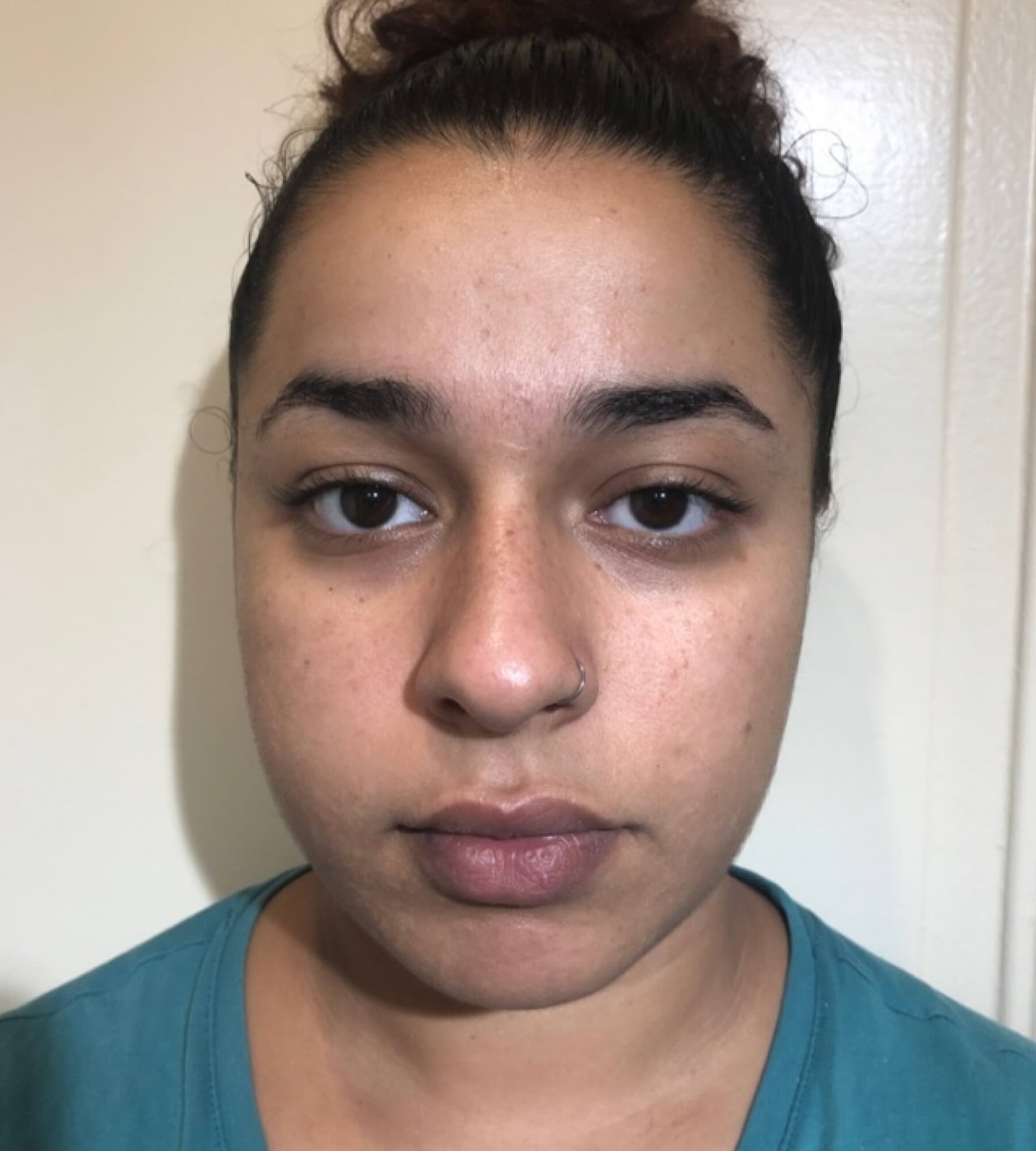 Before treatment
