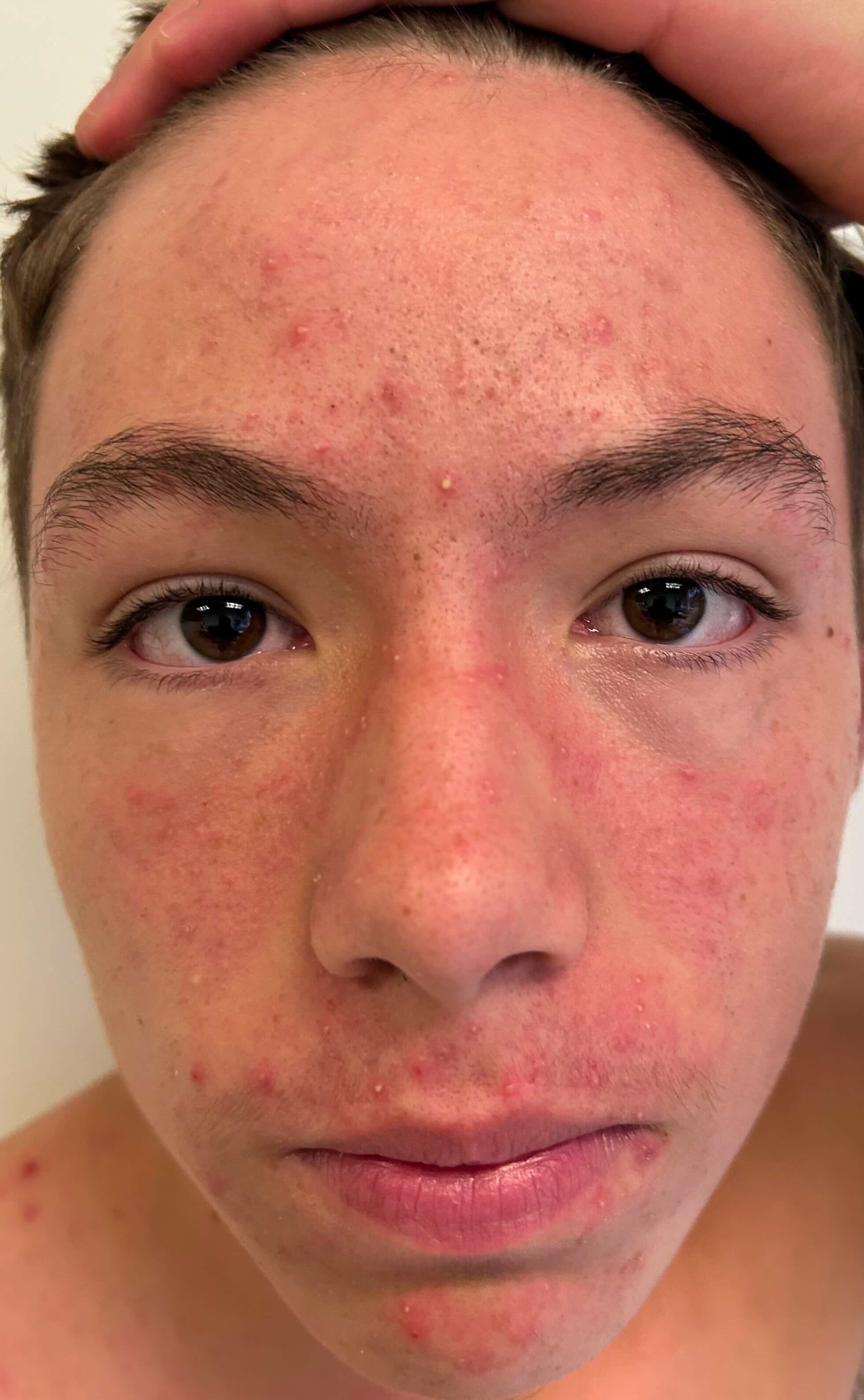 Before treatment