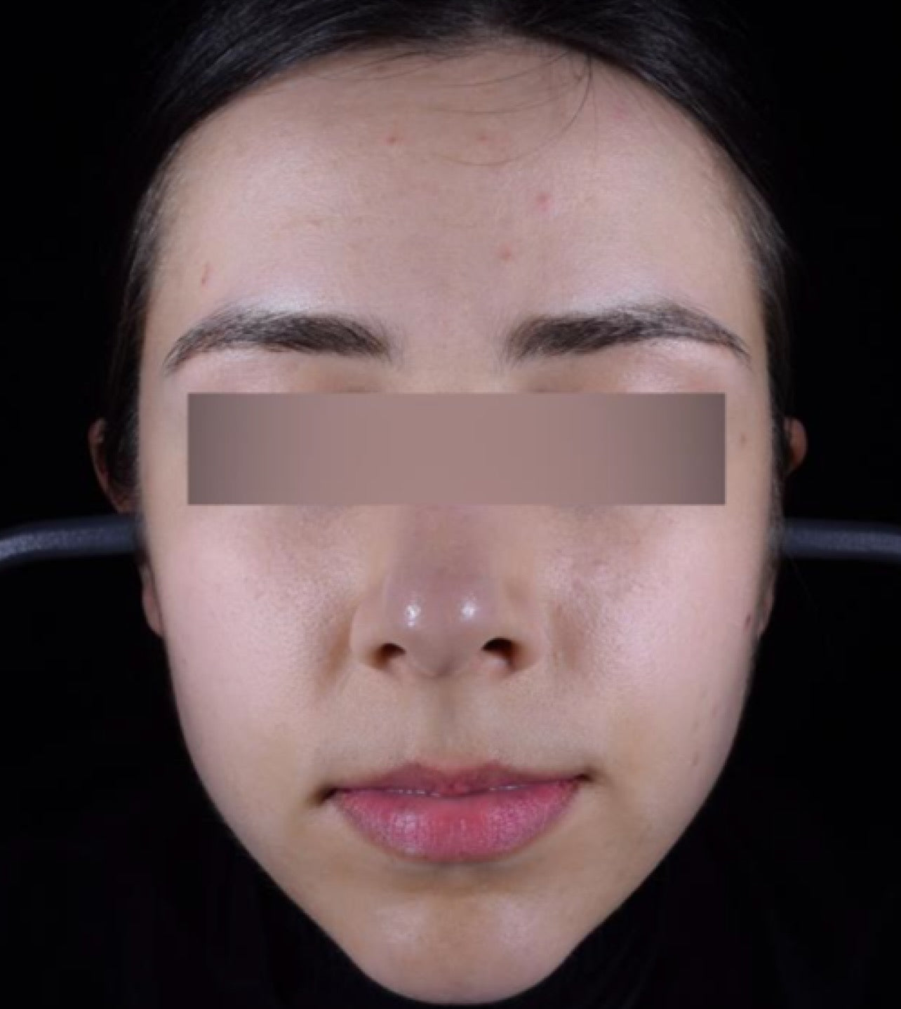 Before treatment