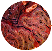 GUT DYSBIOSIS & INFLAMMATION