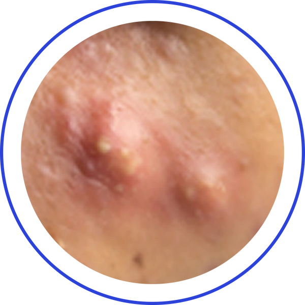 Cystic