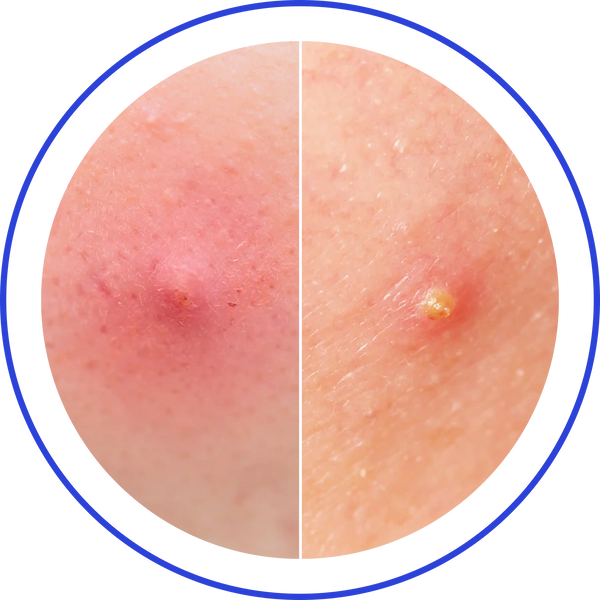 Inflammatory