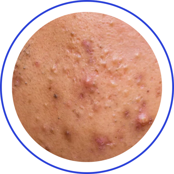 Nodular