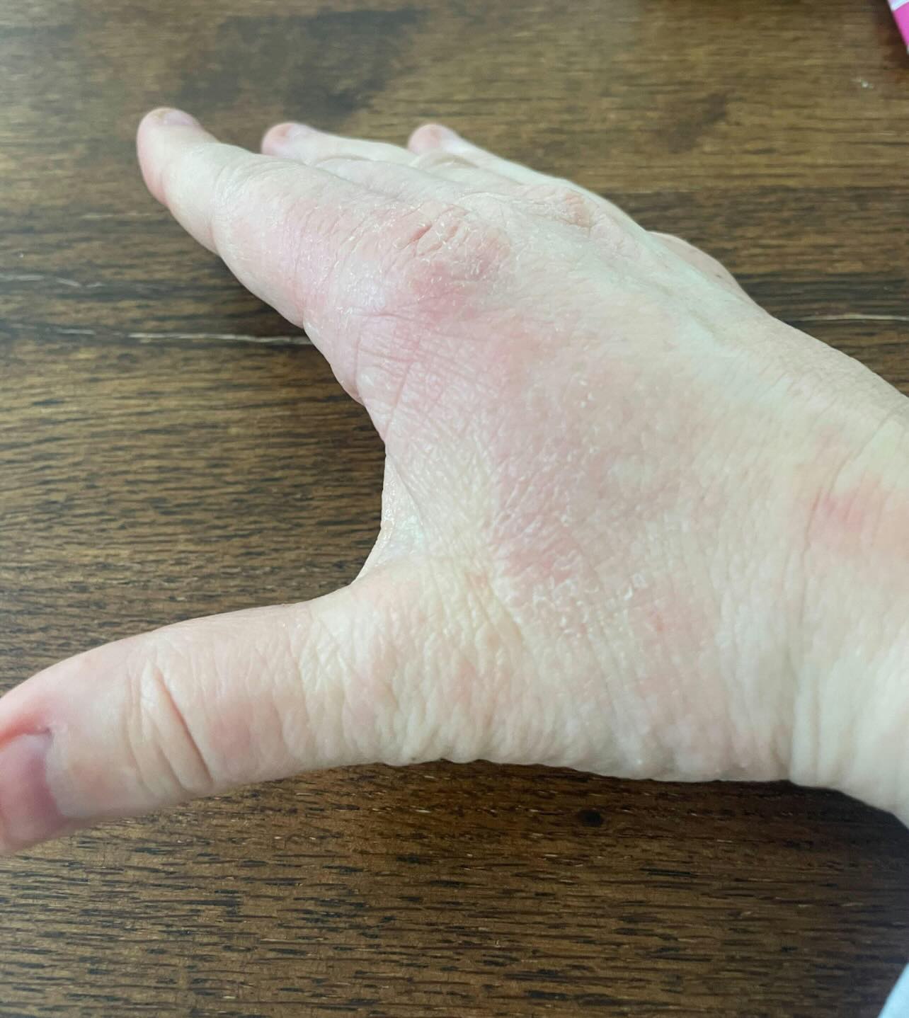 After treatment