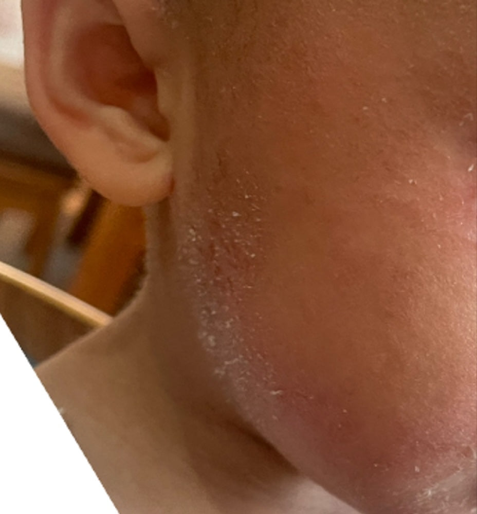 After treatment