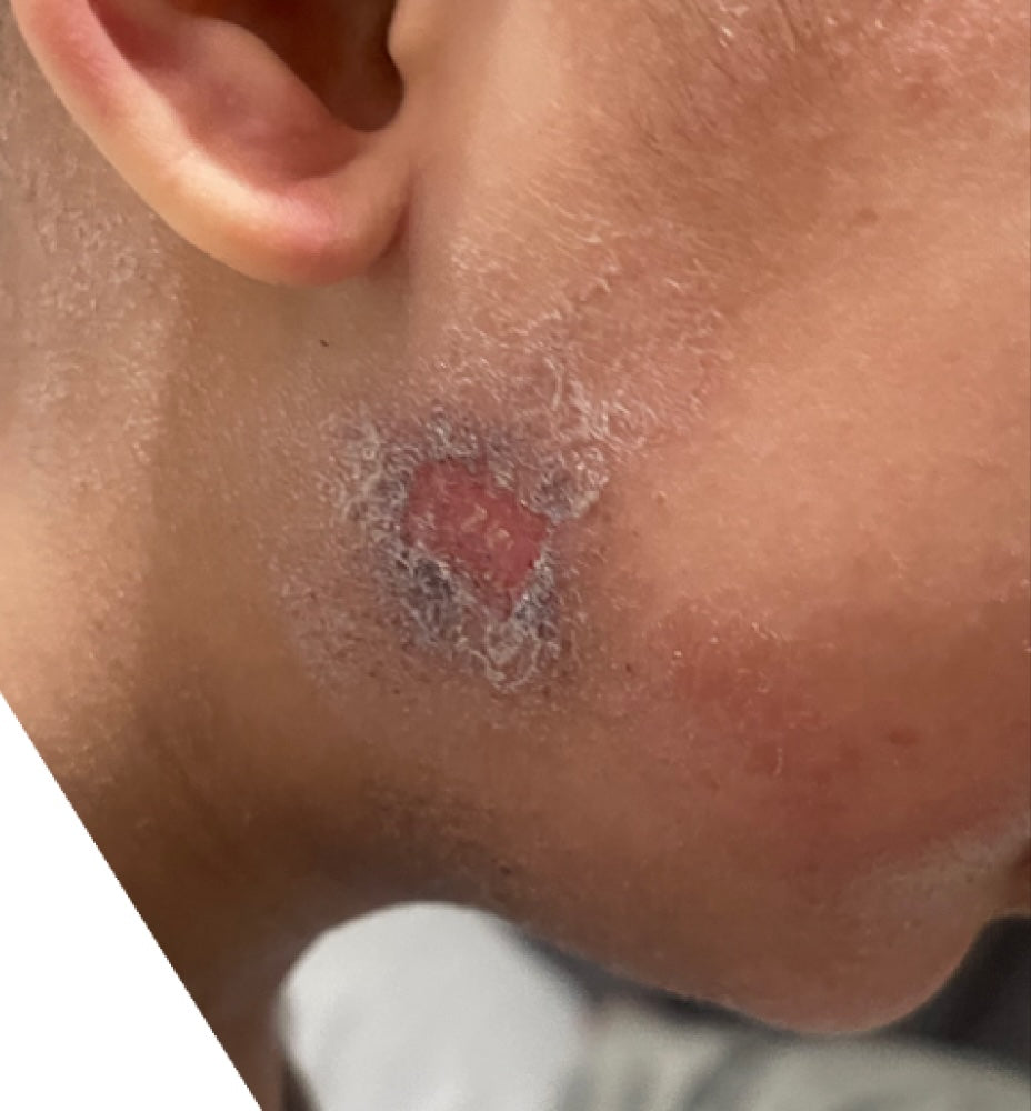 Before treatment