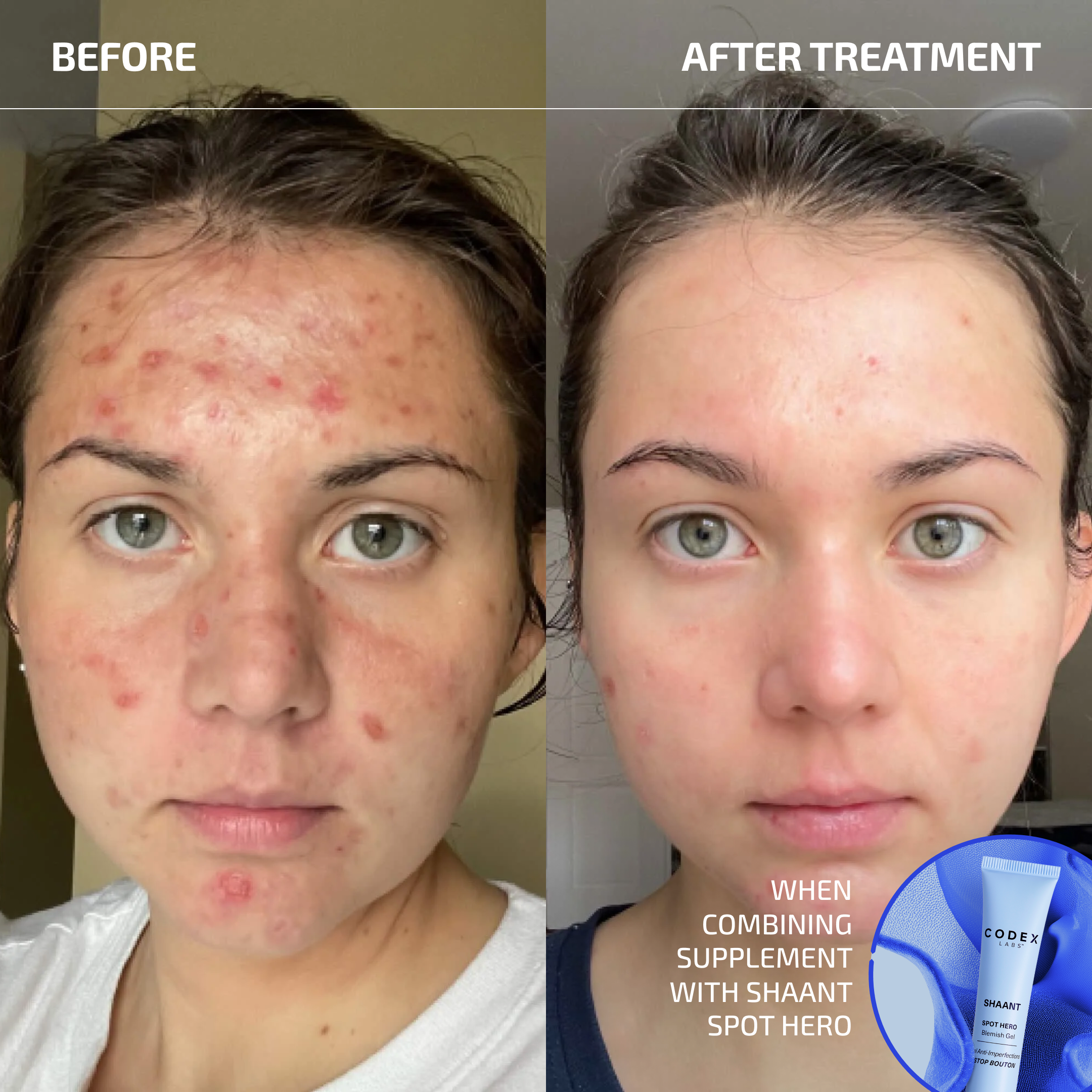 SHAANT ClearSkin Acne Relief Probiotic Supplement 2.0