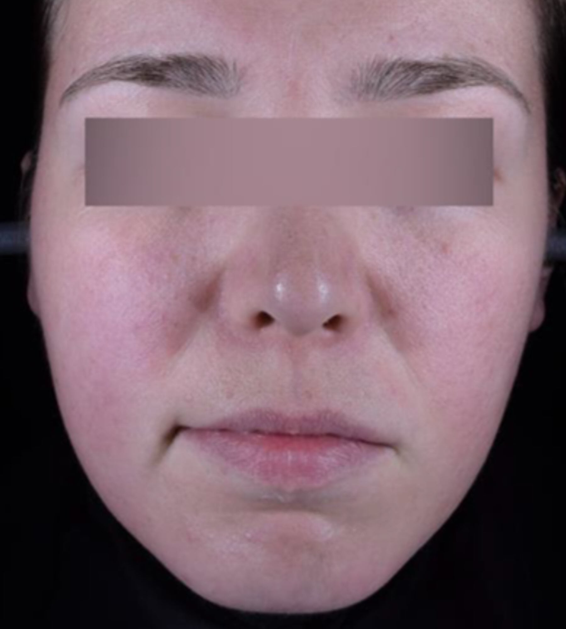 Before treatment