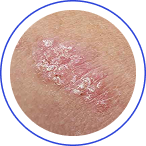 PLAQUE PSORIASIS