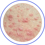 GUTTATE PSORIASIS