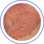 INVERSE PSORIASIS