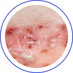 PUSTULAR PSORIASIS