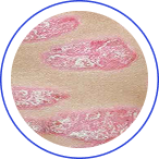 ERYTHTODERMIC PSORIASIS